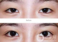 成都割雙眼皮哪里專業(yè)？割雙眼皮介紹？