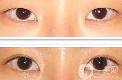 成都割雙眼皮哪里專業(yè)？割雙眼皮介紹？