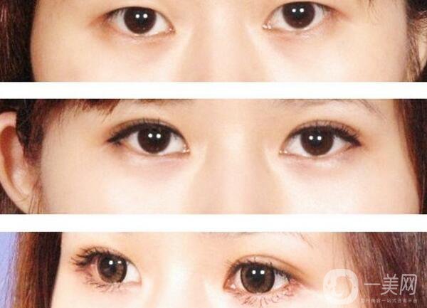 割雙眼皮要花多少錢？割雙眼皮手術(shù)價(jià)格詳細(xì)解析