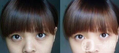 黑眼圈可以打玻尿酸嗎？玻尿酸去黑眼圈*果如何？