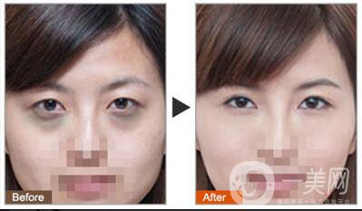 黑眼圈可以打玻尿酸嗎？玻尿酸去黑眼圈*果如何？