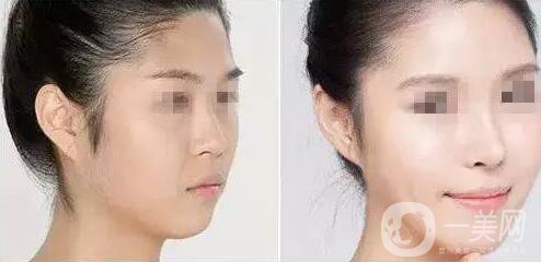 上海假體隆鼻多少費(fèi)用？假體隆鼻價(jià)格詳細(xì)分析