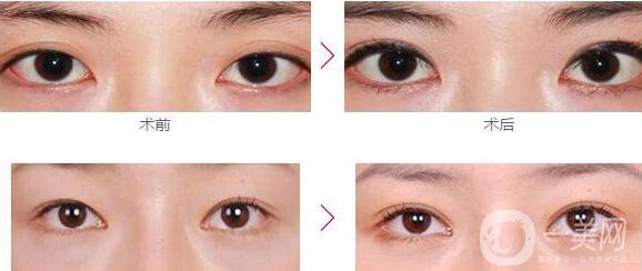  杭州割雙眼皮價(jià)格貴不貴