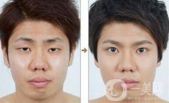 男士割雙眼皮果怎樣？有哪些方式？