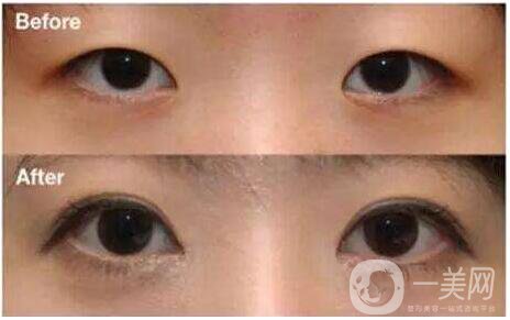 割雙眼皮和開眼角*果好嗎 *果圖分享