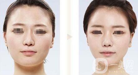 臉部削骨手術(shù)多少錢？削骨瘦臉價格詳解