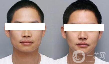 臉部削骨手術(shù)多少錢？削骨瘦臉價格詳解