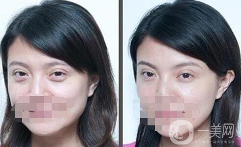 北京去眼袋手術(shù)多少錢？去眼袋價格詳細(xì)解析