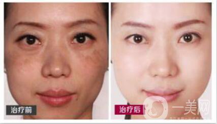 激光調(diào)節(jié)黃褐斑要多少錢？激光祛黃褐斑價(jià)格價(jià)格分析