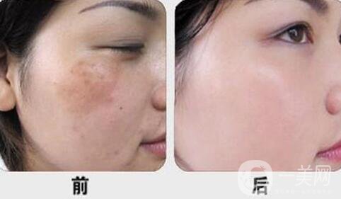 激光調(diào)節(jié)黃褐斑要多少錢？激光祛黃褐斑價(jià)格價(jià)格分析