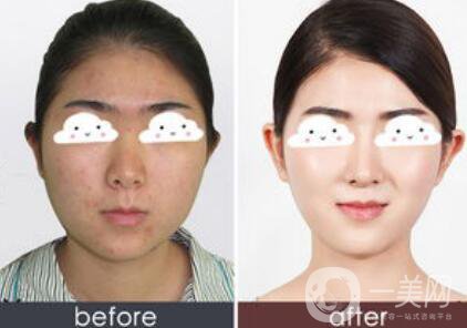 光子嫩膚*果怎么樣？光子嫩膚多長時間做一次？