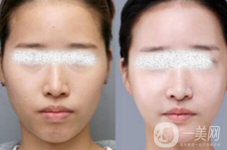 光子嫩膚*果怎么樣？光子嫩膚多長時間做一次？