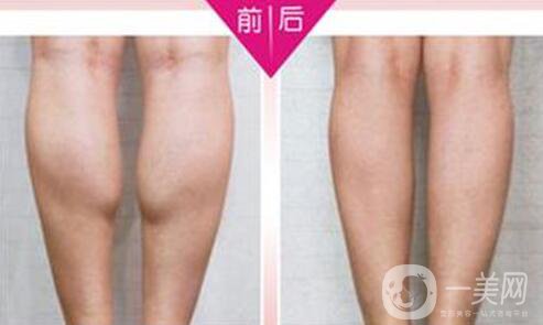 **果好嗎？*多少錢一針？