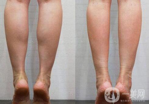 **果好嗎？*多少錢一針？