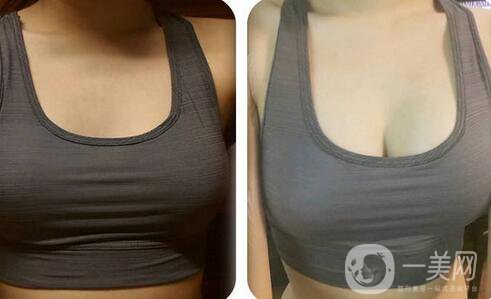 隆乳多少錢 隆胸價(jià)格與那些因素有關(guān)