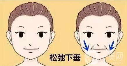 去鼻唇溝多少錢 價(jià)格明細(xì)盤點(diǎn)