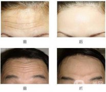 抬頭紋怎么去？去抬頭紋的方法？