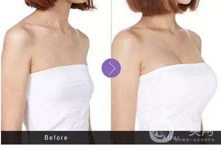 妙桃假體隆胸多少錢 收費(fèi)明細(xì)詳解