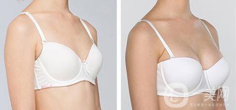 隆胸材料有哪些牌子？有哪些優(yōu)缺點？