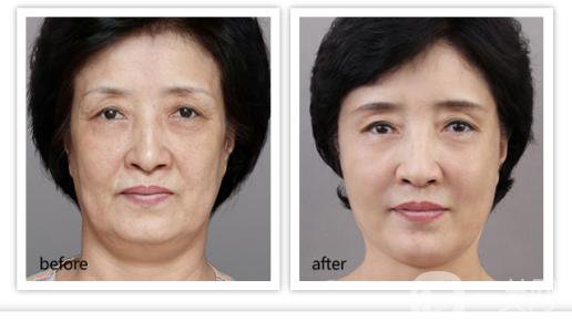 *除皺價(jià)格是多少錢？有哪些影響因素？