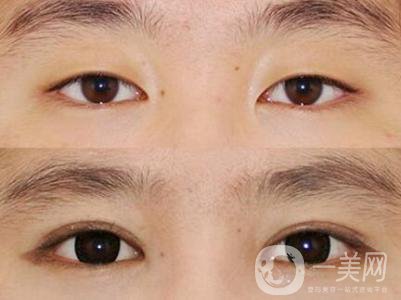 高分子雙眼皮是*嗎?高分子雙眼皮適合哪些人？