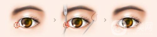 開眼角有危險嗎？有些什么后遺癥？