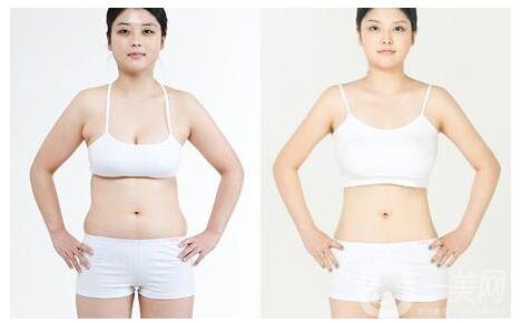 深圳做環(huán)形吸脂價(jià)格要多少錢