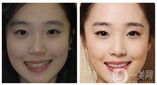 烤瓷牙的種類有哪些 烤瓷牙有幾種類型