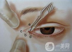 開(kāi)眼角有風(fēng)險(xiǎn)嗎？開(kāi)眼角風(fēng)險(xiǎn)有哪些？