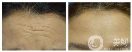 怎樣治抬頭紋 去除抬頭紋的方法有哪些