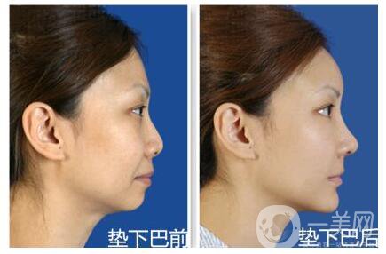 墊下巴后多久可以按摩 術(shù)后如何護理
