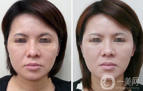 光子嫩膚大概要多少錢？光子嫩膚價格詳解