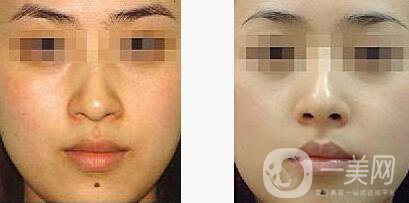 光子嫩膚適合人群有哪些？光子嫩膚不適合哪些人？