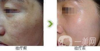 光子嫩膚調(diào)節(jié)黃褐斑*果怎么樣？去黃褐斑圖