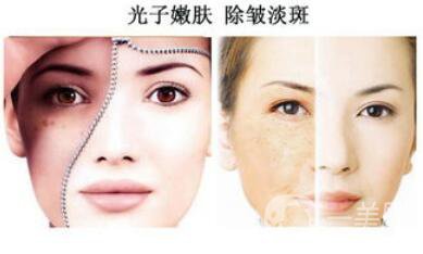 光子嫩膚如何護理？光子嫩膚的注意事項