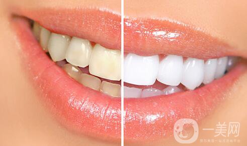 四環(huán)素牙怎么變白？四環(huán)素牙怎么辦？