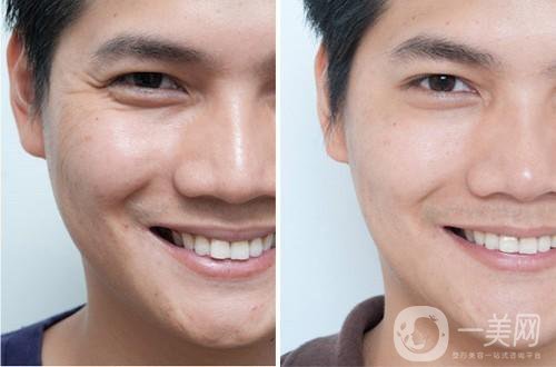 去魚(yú)尾紋的方法有哪些？玻尿酸去魚(yú)尾紋怎么樣？