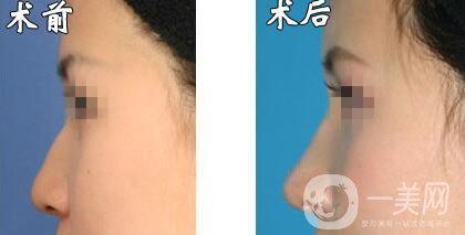 瑞蘭玻尿酸隆鼻價格需要多少?所需費用詳解