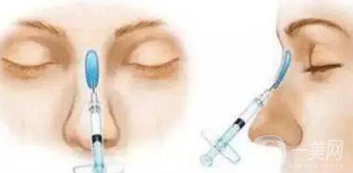 瑞蘭玻尿酸隆鼻價格需要多少?所需費用詳解