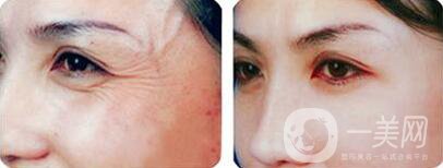 怎樣去魚(yú)尾紋*果好？去除魚(yú)尾紋的方法介紹