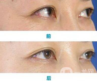 怎樣去魚(yú)尾紋*果好？去除魚(yú)尾紋的方法介紹