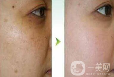 去蝴蝶斑用什么方法好？蝴蝶斑調(diào)節(jié)方法詳細(xì)介紹
