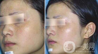 去蝴蝶斑用什么方法好？蝴蝶斑調(diào)節(jié)方法詳細(xì)介紹