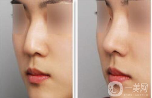 駝峰鼻矯正需要多少錢？駝峰鼻矯正費(fèi)用詳解