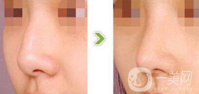 駝峰鼻矯正需要多少錢？駝峰鼻矯正費(fèi)用詳解