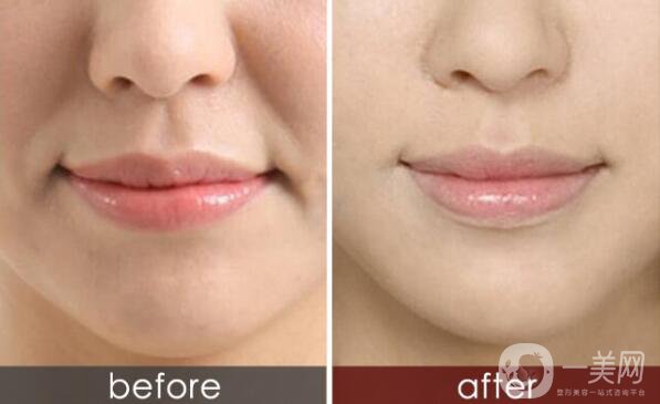 怎么除去法令紋？什么方法可以去法令紋？