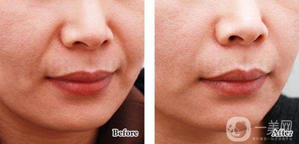 法令紋怎樣消除*果*好？該怎么樣做？