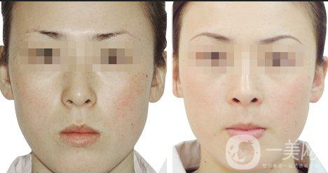 黑臉娃娃的副作用有哪些？怎樣可以減少副作用？