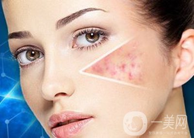 像素激光去痘坑*果怎么樣？怎樣很好的調(diào)節(jié)*果？