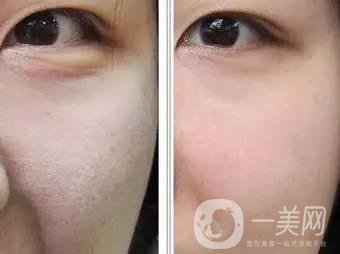 果酸換膚后注意事項盤點大揭秘，該怎么做？